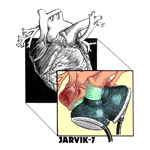 Jarvik7 Medical Illustration