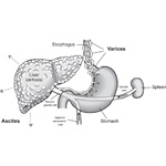 Liver Cirrhosis Medical Illustration